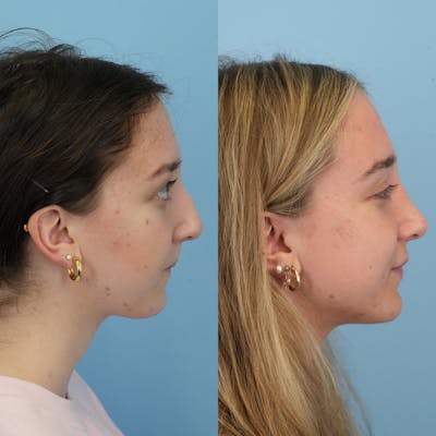 Rhinoplasty Before & After Gallery - Patient 399630 - Image 4