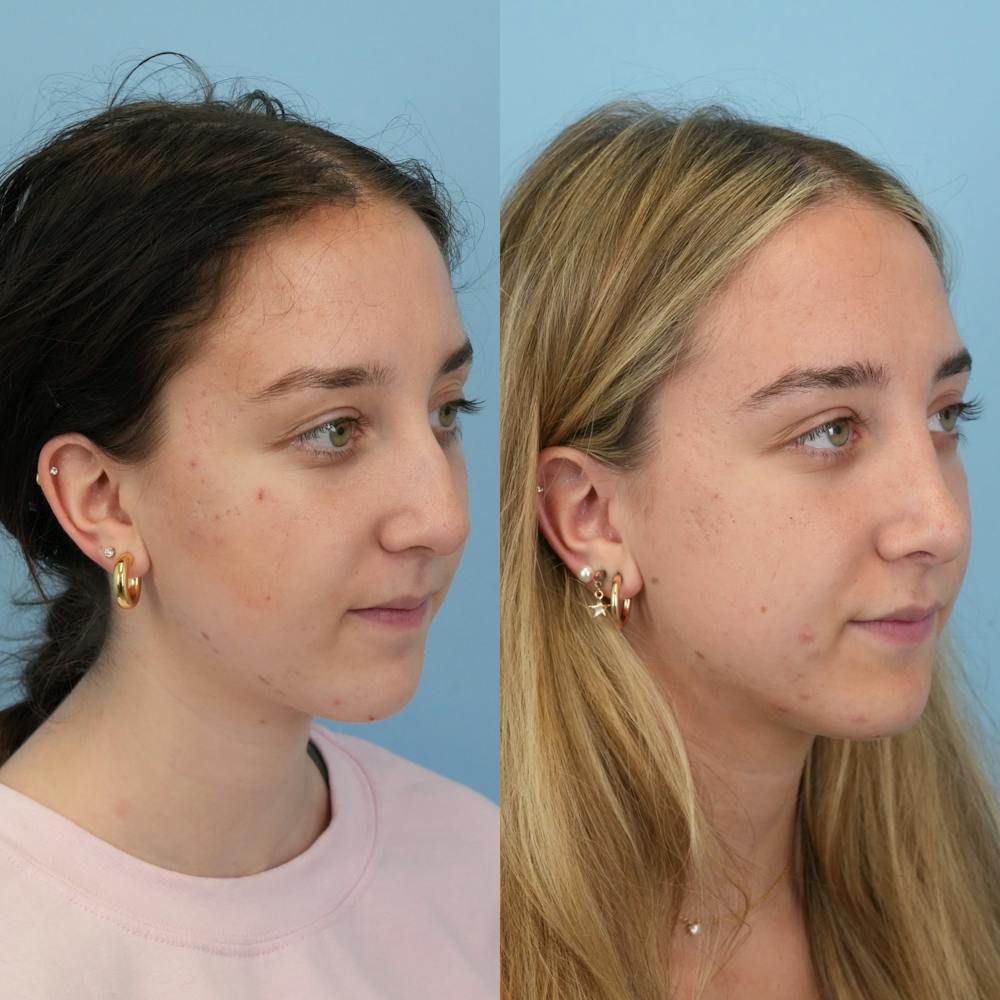 Rhinoplasty Before & After Gallery - Patient 399630 - Image 3