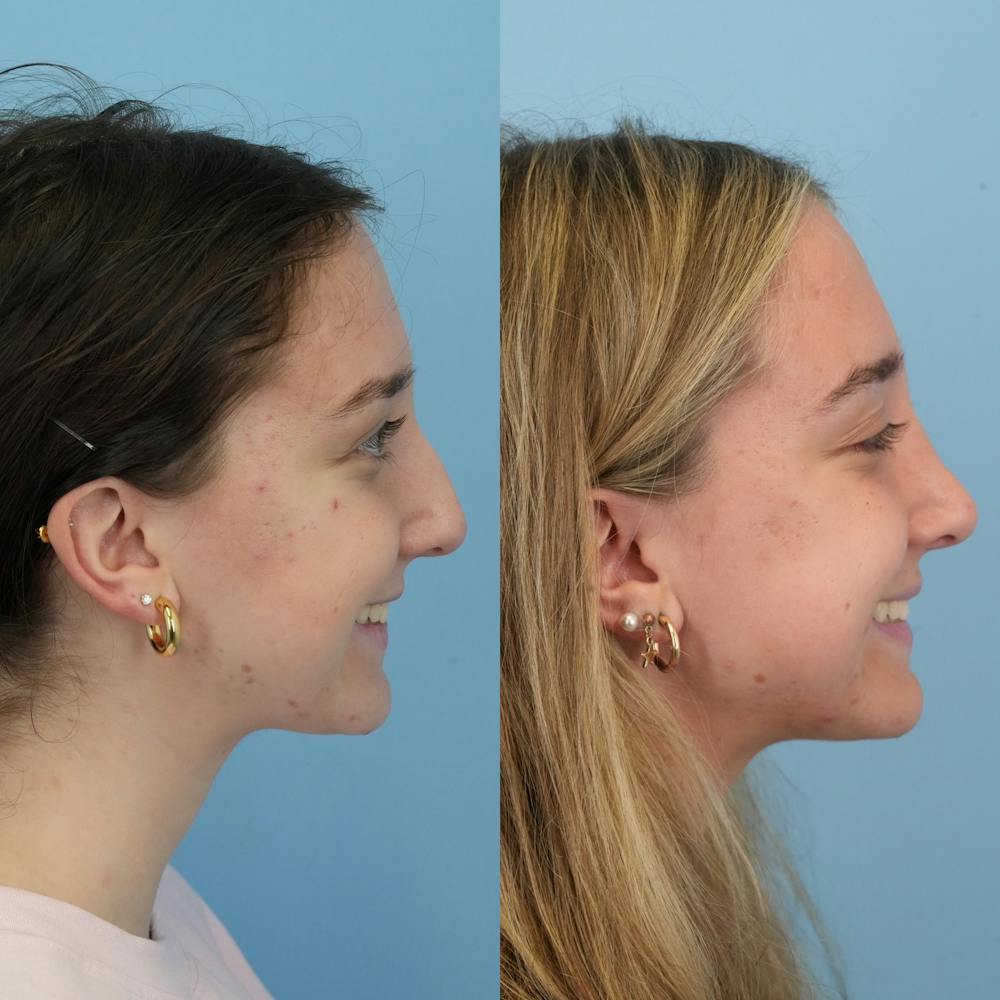 Rhinoplasty Before & After Gallery - Patient 399630 - Image 5