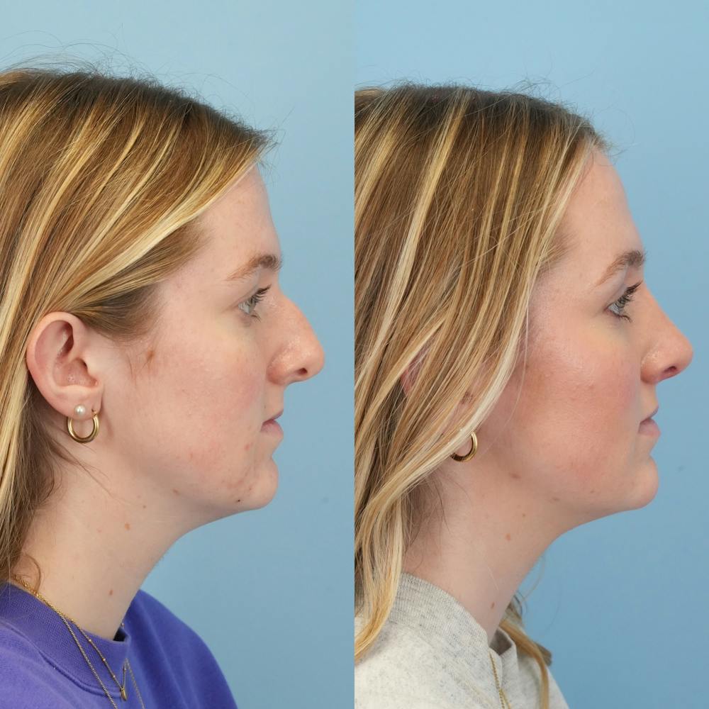 Rhinoplasty Before & After Gallery - Patient 113325 - Image 3