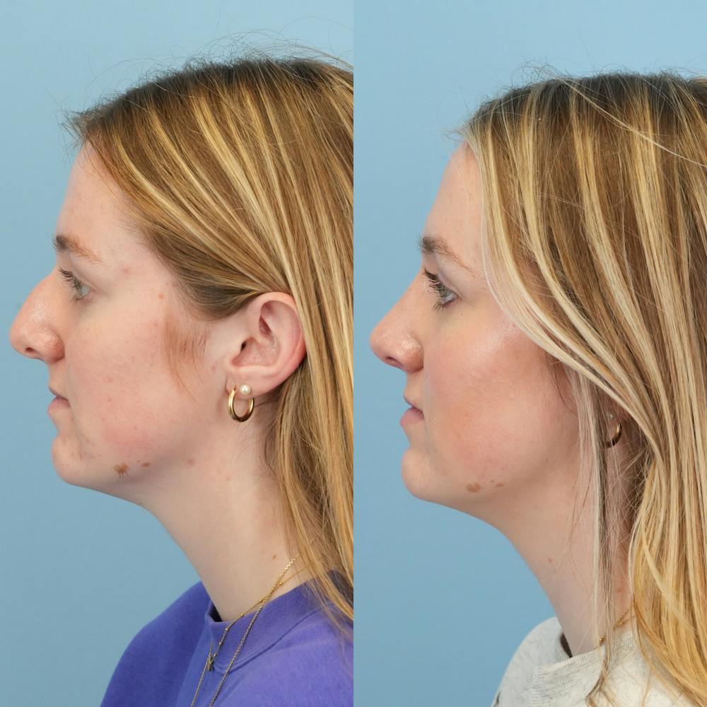Rhinoplasty Before & After Gallery - Patient 113325 - Image 6