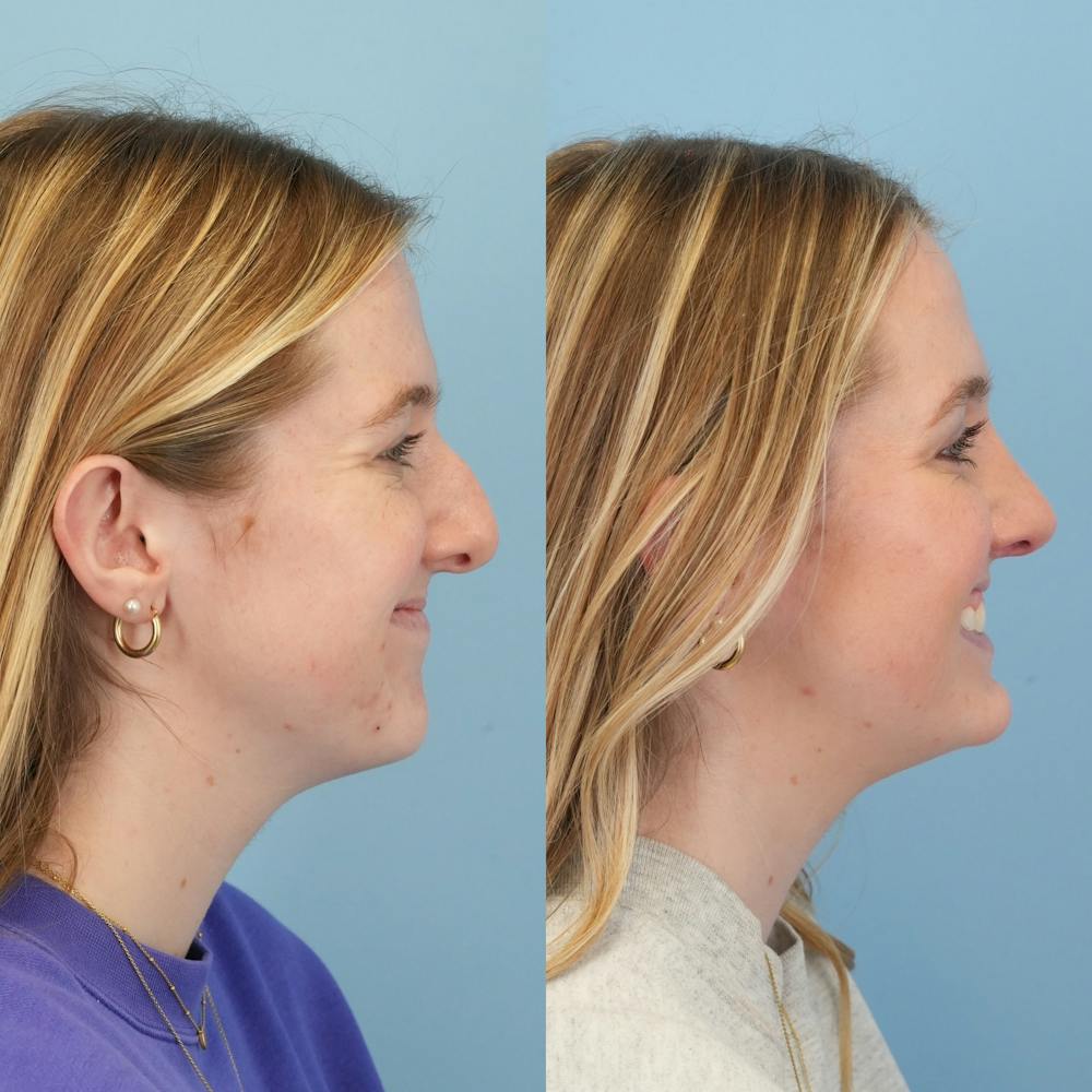 Rhinoplasty Before & After Gallery - Patient 113325 - Image 4