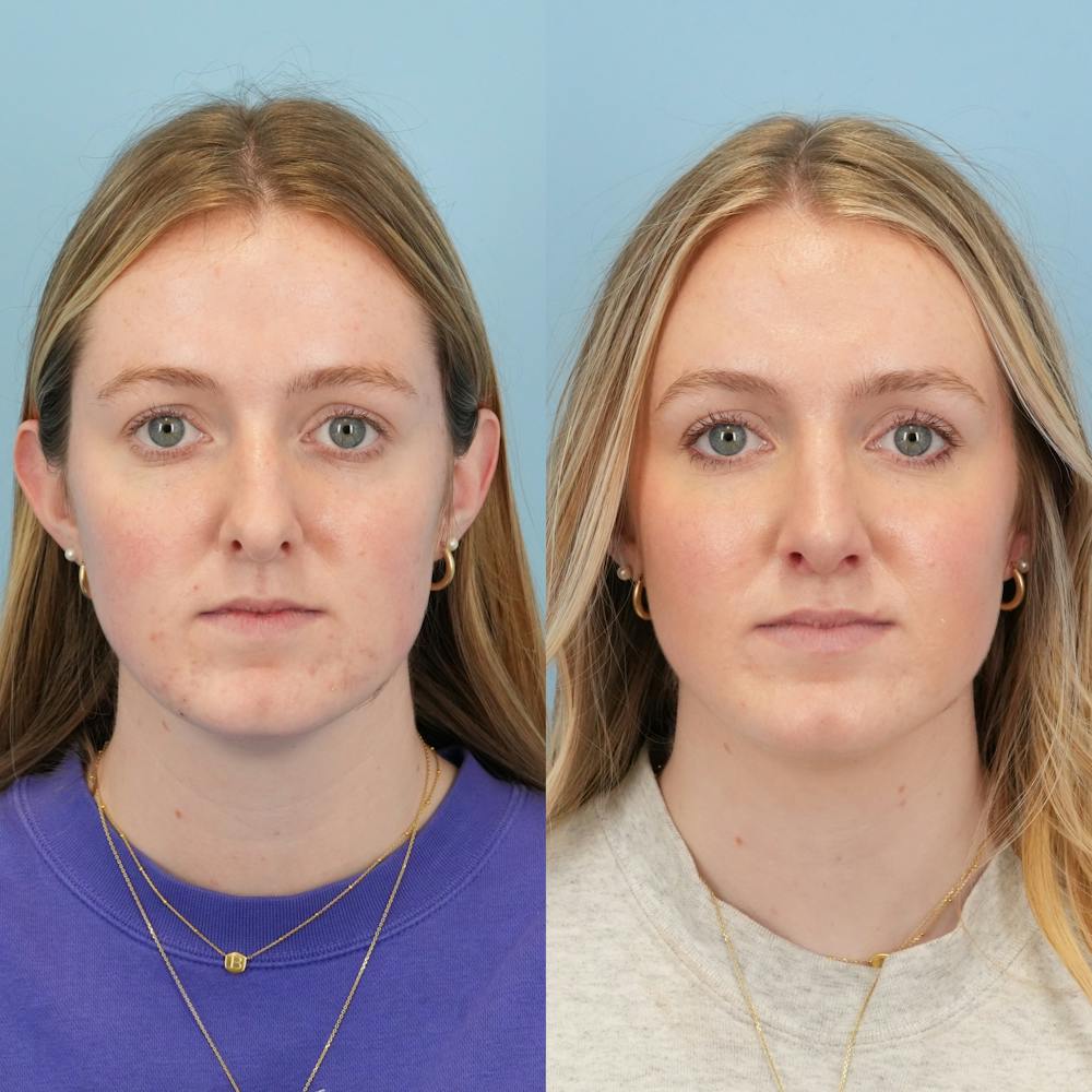 Rhinoplasty Before & After Gallery - Patient 113325 - Image 1