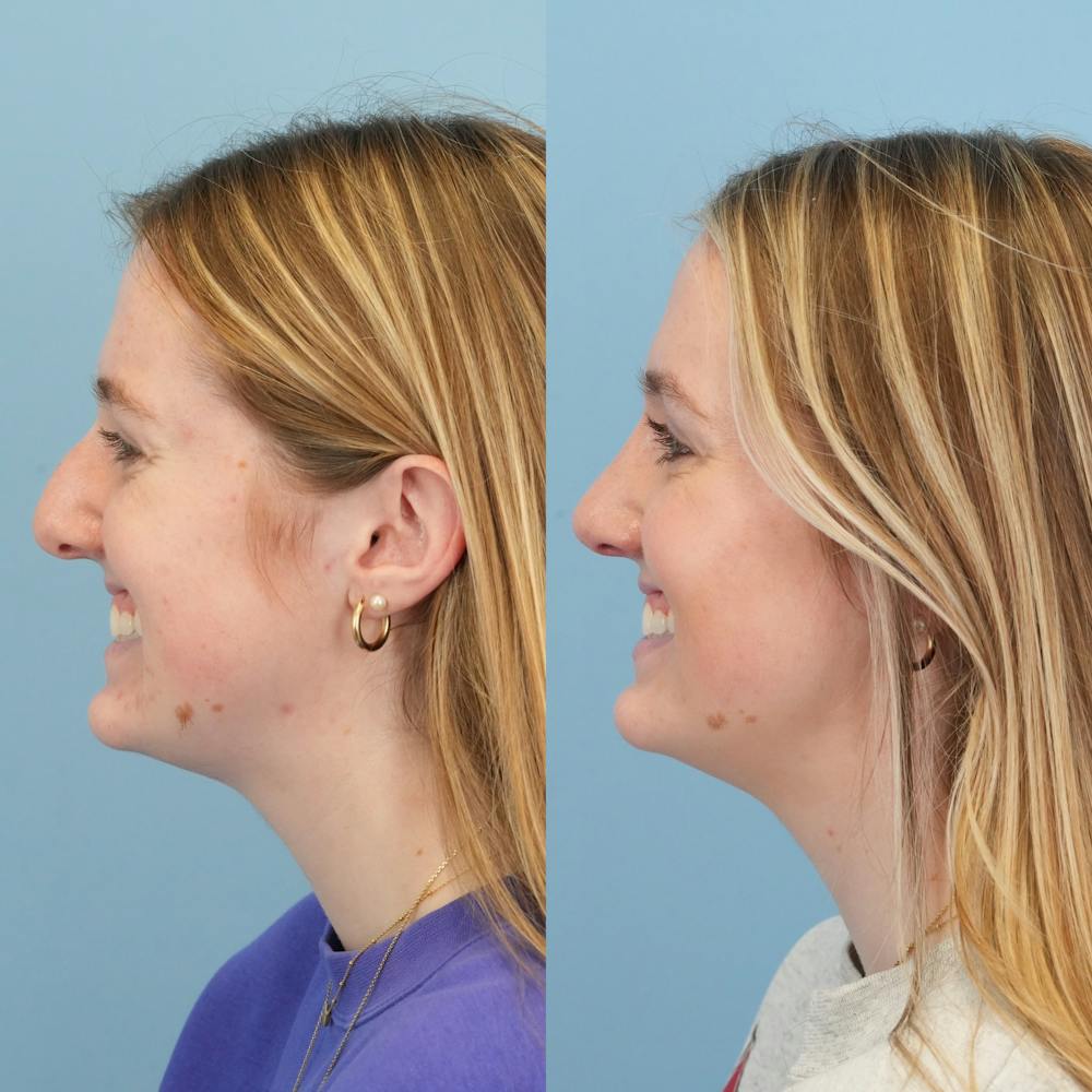 Rhinoplasty Before & After Gallery - Patient 113325 - Image 7