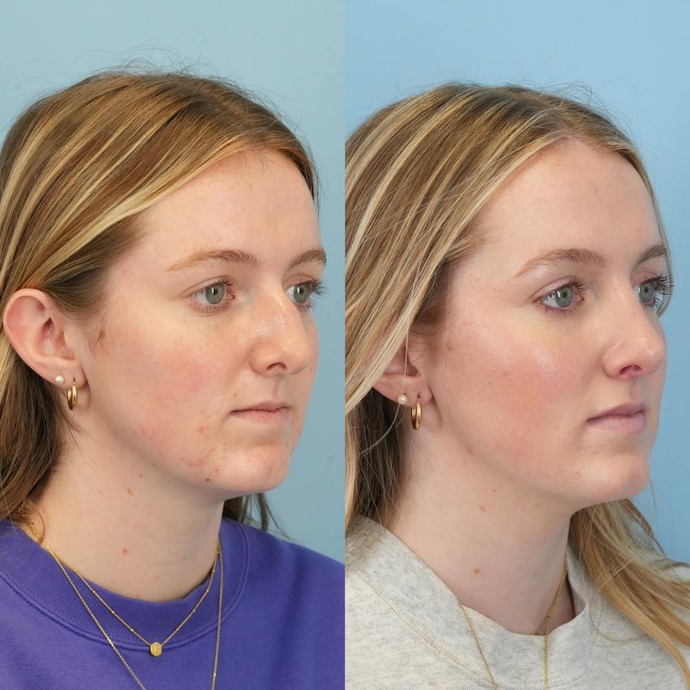 Rhinoplasty Before & After Gallery - Patient 113325 - Image 2