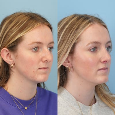 Rhinoplasty Before & After Gallery - Patient 113325 - Image 2