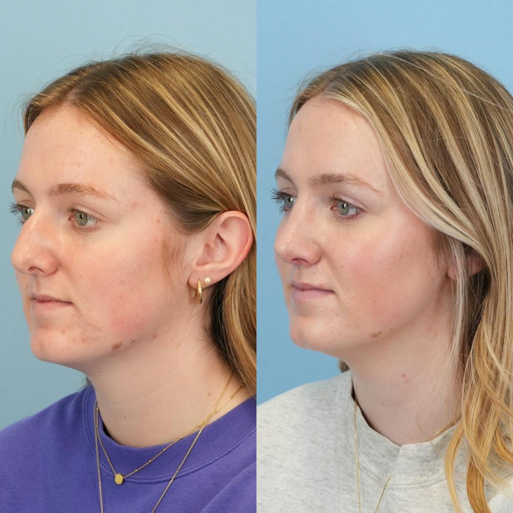 Rhinoplasty Before & After Gallery - Patient 113325 - Image 5