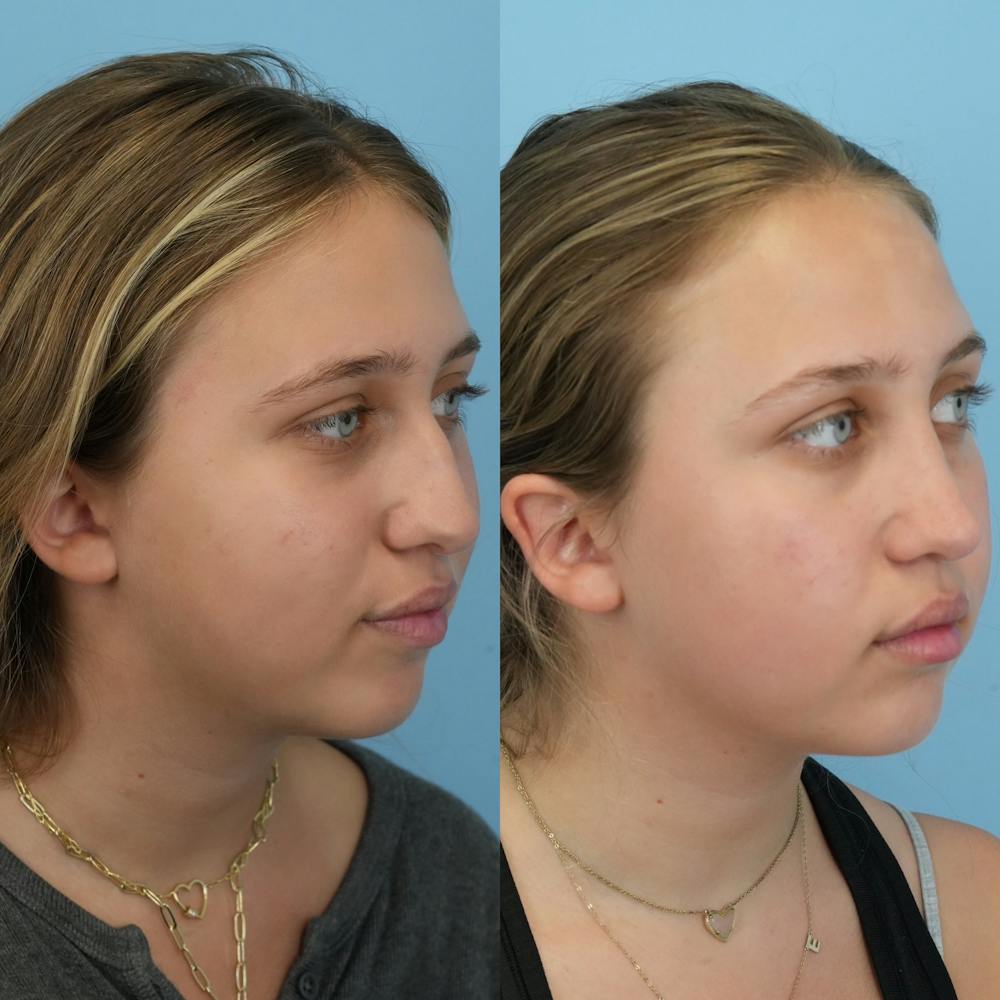 Rhinoplasty Before & After Gallery - Patient 255652 - Image 2