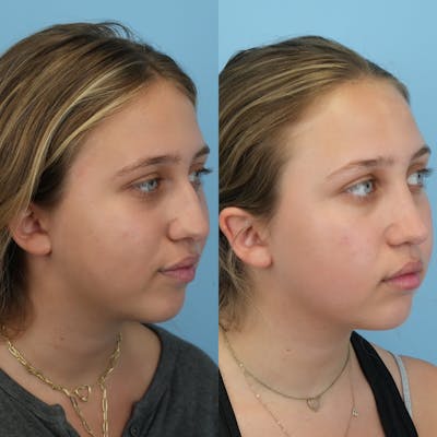 Rhinoplasty Before & After Gallery - Patient 255652 - Image 2