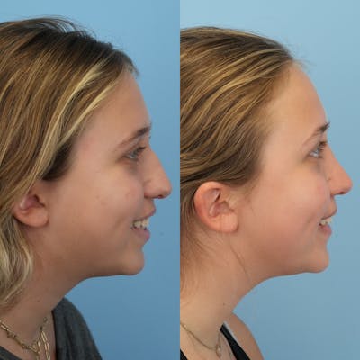 Rhinoplasty Before & After Gallery - Patient 255652 - Image 4
