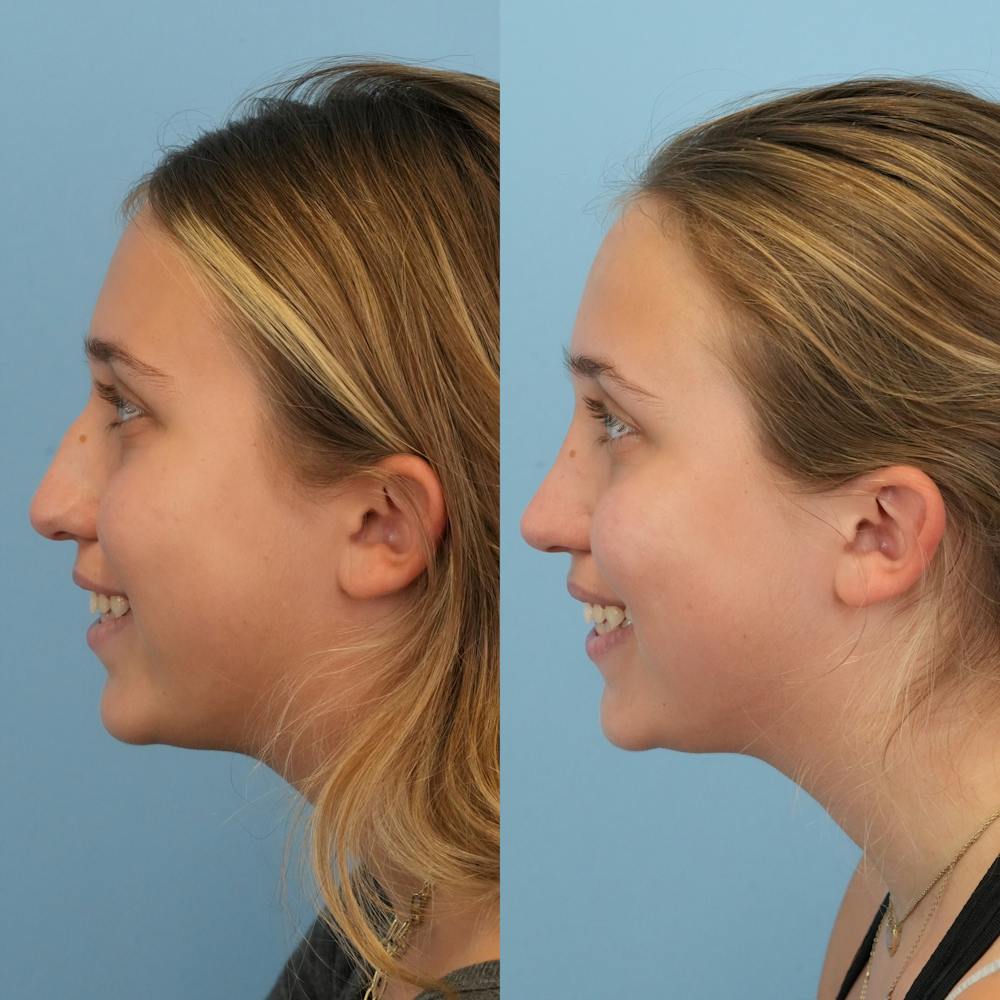 Rhinoplasty Before & After Gallery - Patient 255652 - Image 7