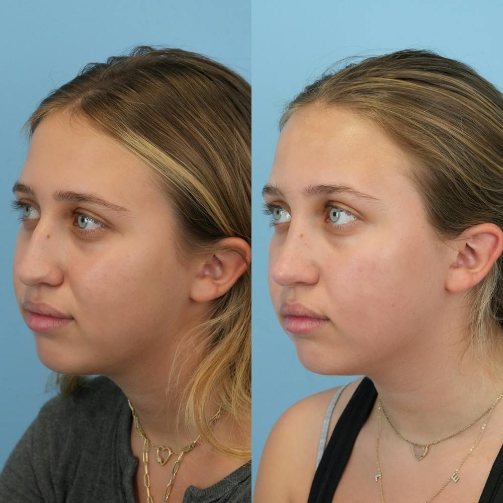 Rhinoplasty Before & After Gallery - Patient 255652 - Image 5