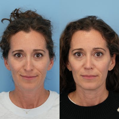 Revision Rhinoplasty Before & After Gallery - Patient 162291 - Image 4