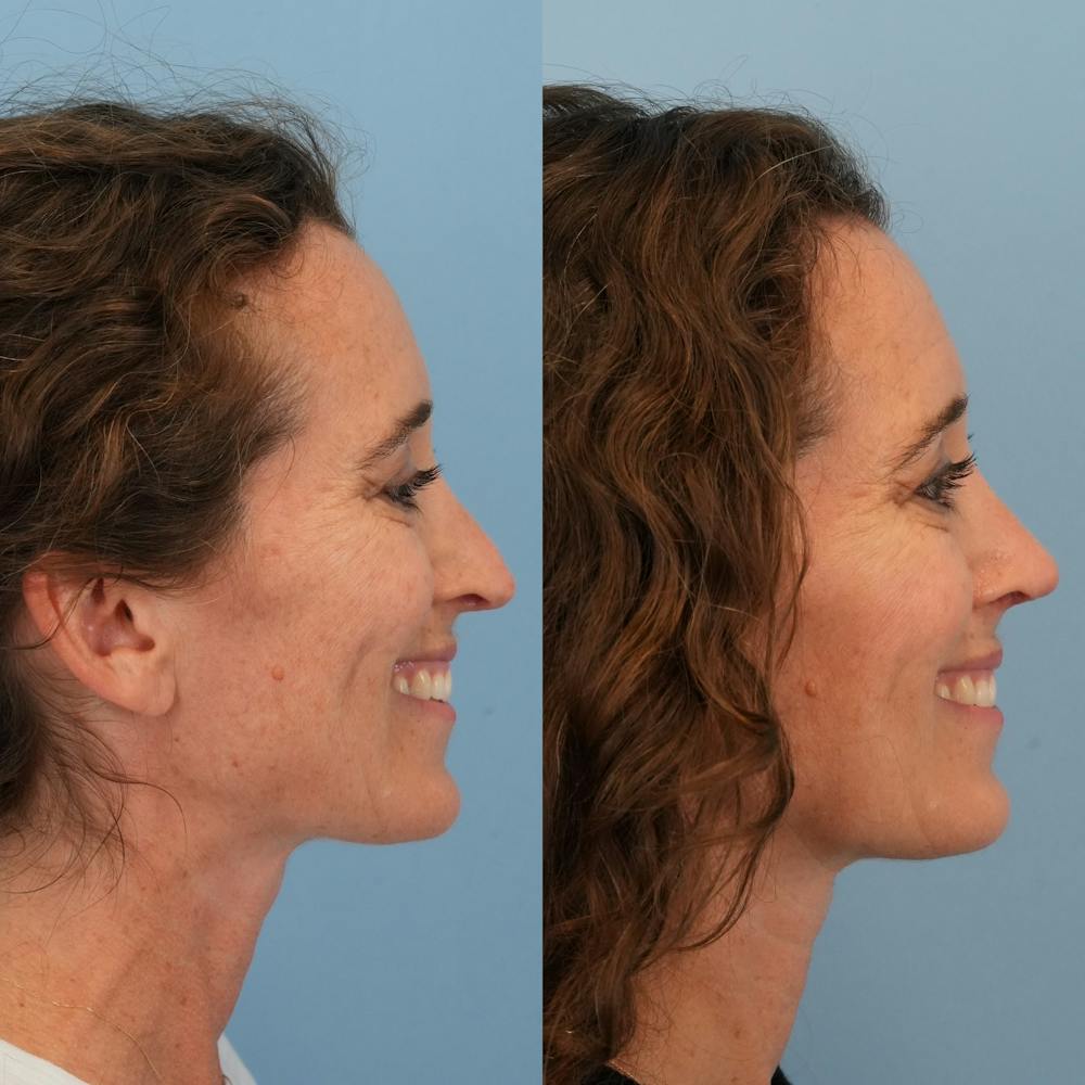 Revision Rhinoplasty Before & After Gallery - Patient 162291 - Image 8