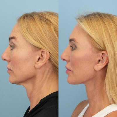 Facelift Before & After Gallery - Patient 178516 - Image 6