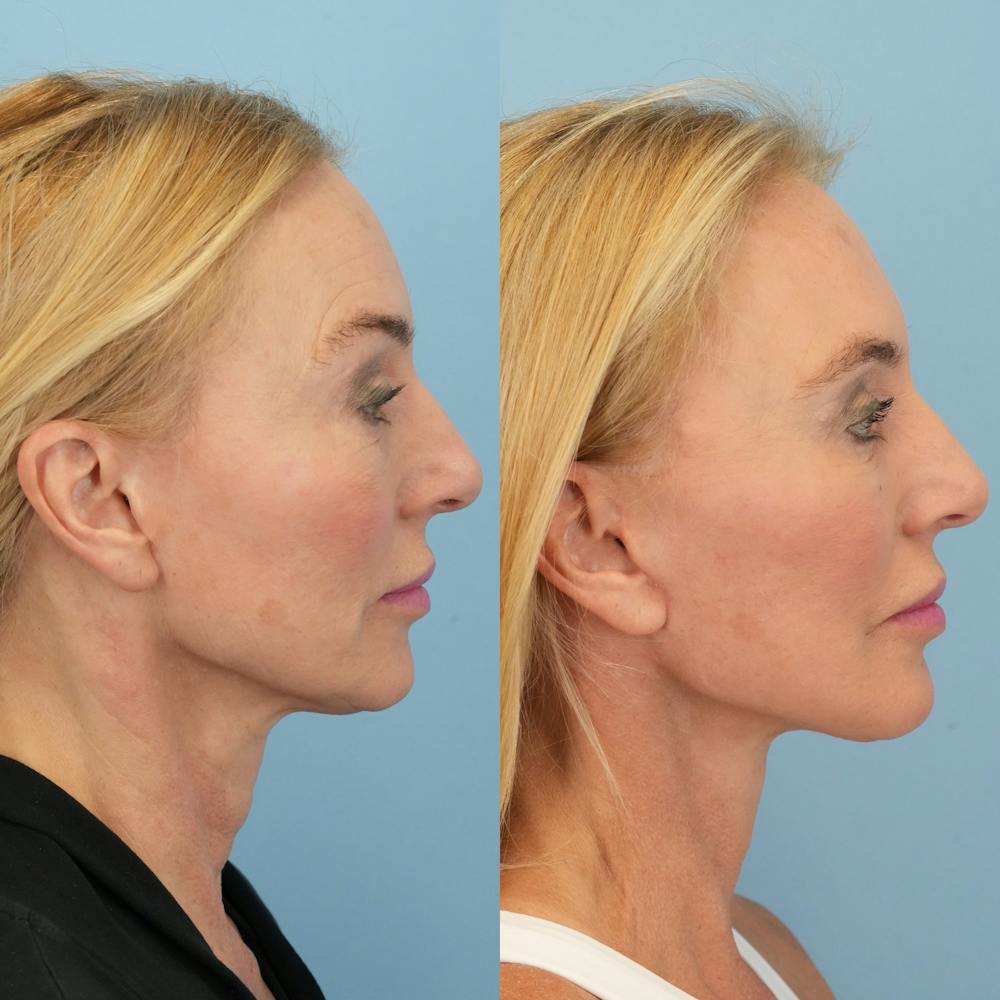 Facelift Before & After Gallery - Patient 178516 - Image 4