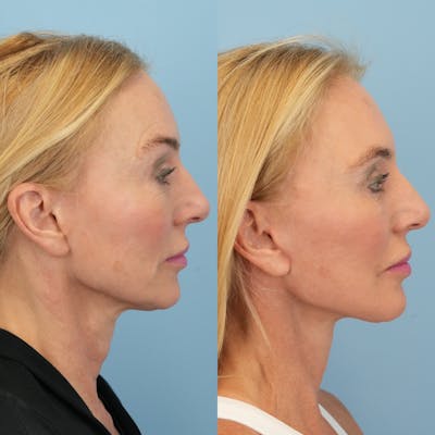 Facelift Before & After Gallery - Patient 178516 - Image 4