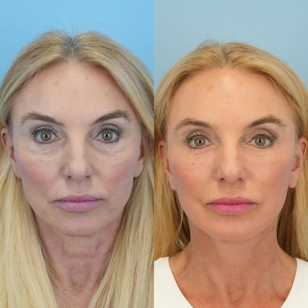 Facelift Before & After Gallery - Patient 178516 - Image 2