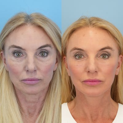 Facelift Before & After Gallery - Patient 178516 - Image 2