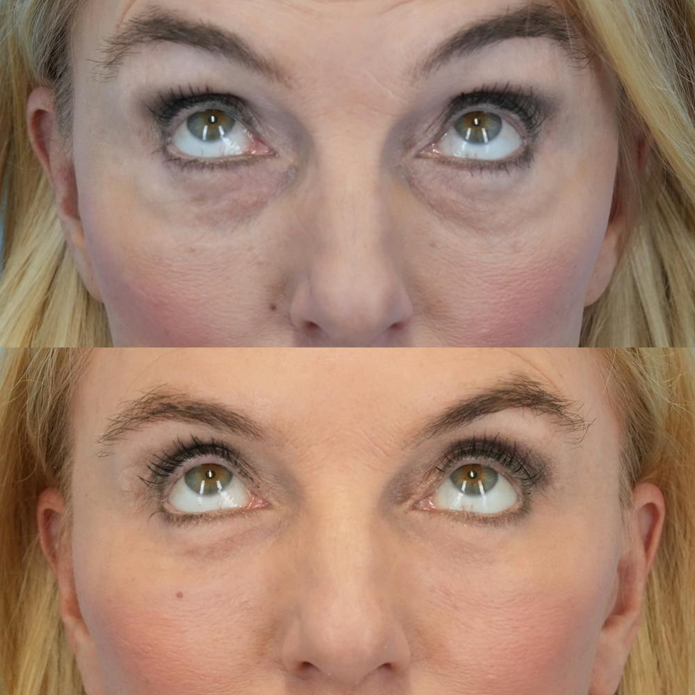 Blepharoplasty Before & After Gallery - Patient 284913 - Image 2