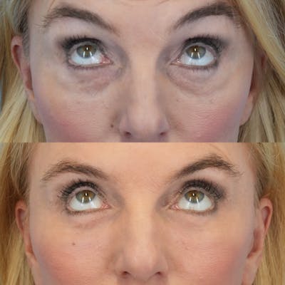 Blepharoplasty Before & After Gallery - Patient 284913 - Image 2