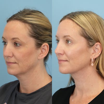 Neck Lift Before & After Gallery - Patient 234279 - Image 4
