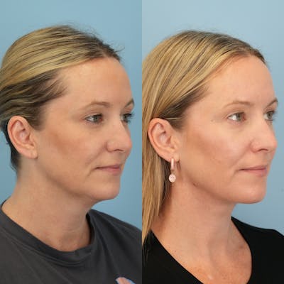 Neck Lift Before & After Gallery - Patient 234279 - Image 2