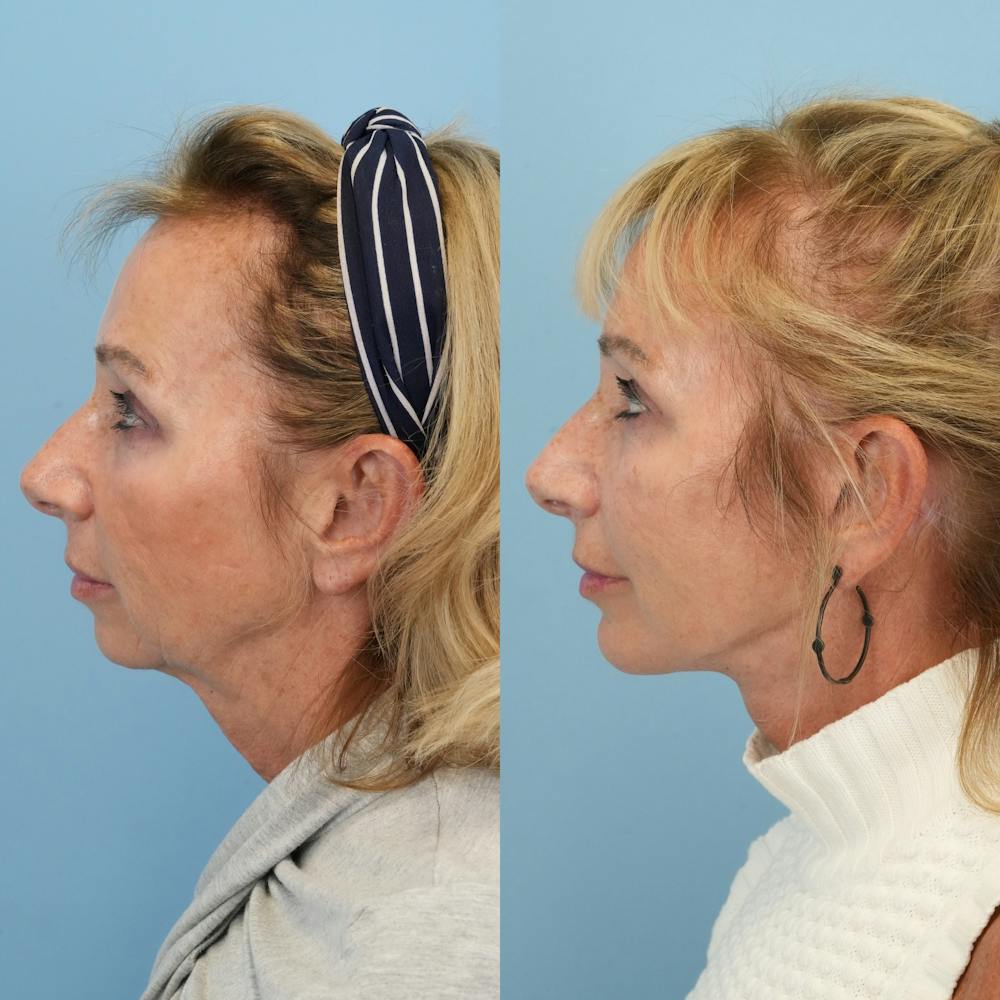 Facelift Before & After Gallery - Patient 155930 - Image 5