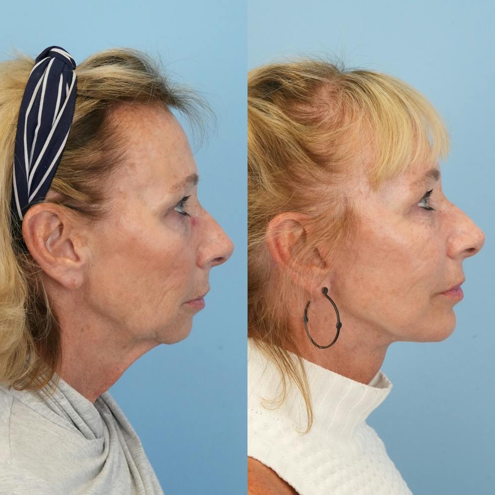 Facelift Before & After Gallery - Patient 155930 - Image 3