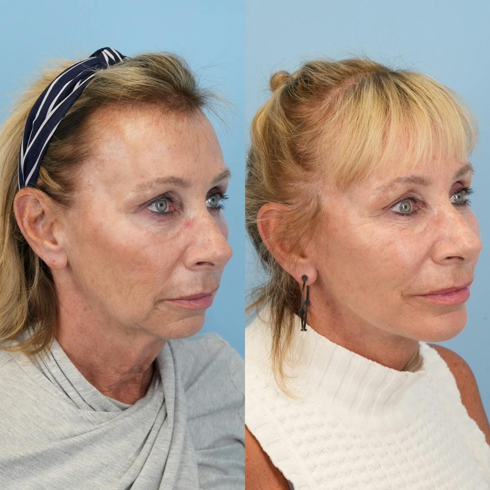 Facelift Before & After Gallery - Patient 155930 - Image 2