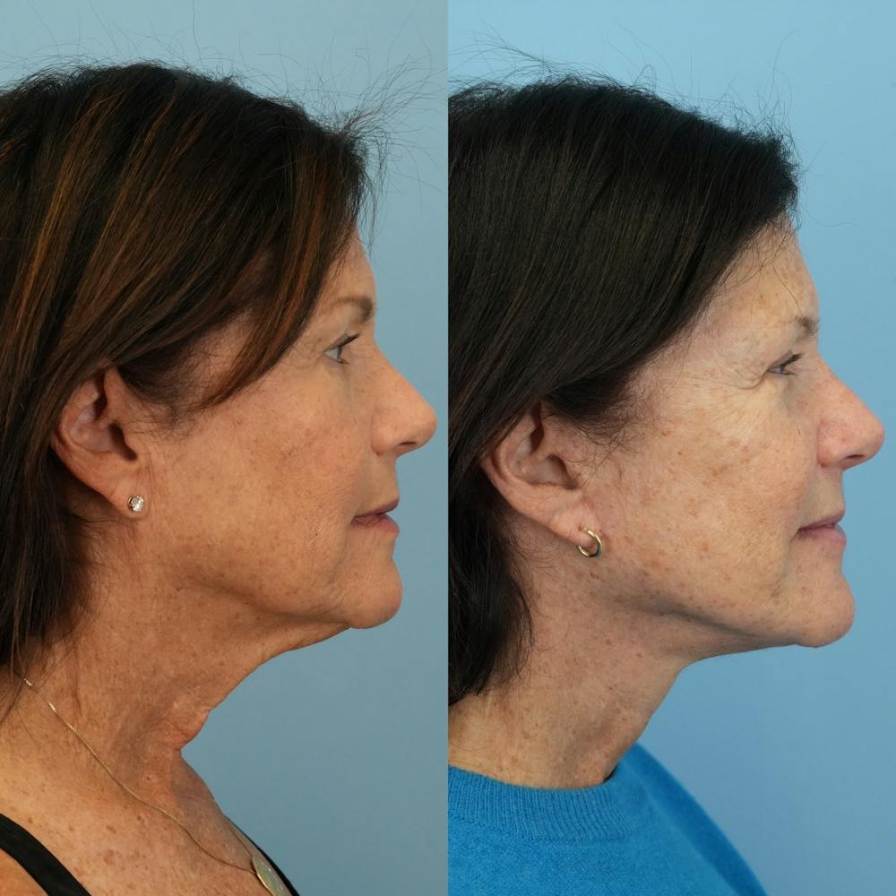Facelift Before & After Gallery - Patient 385570 - Image 3