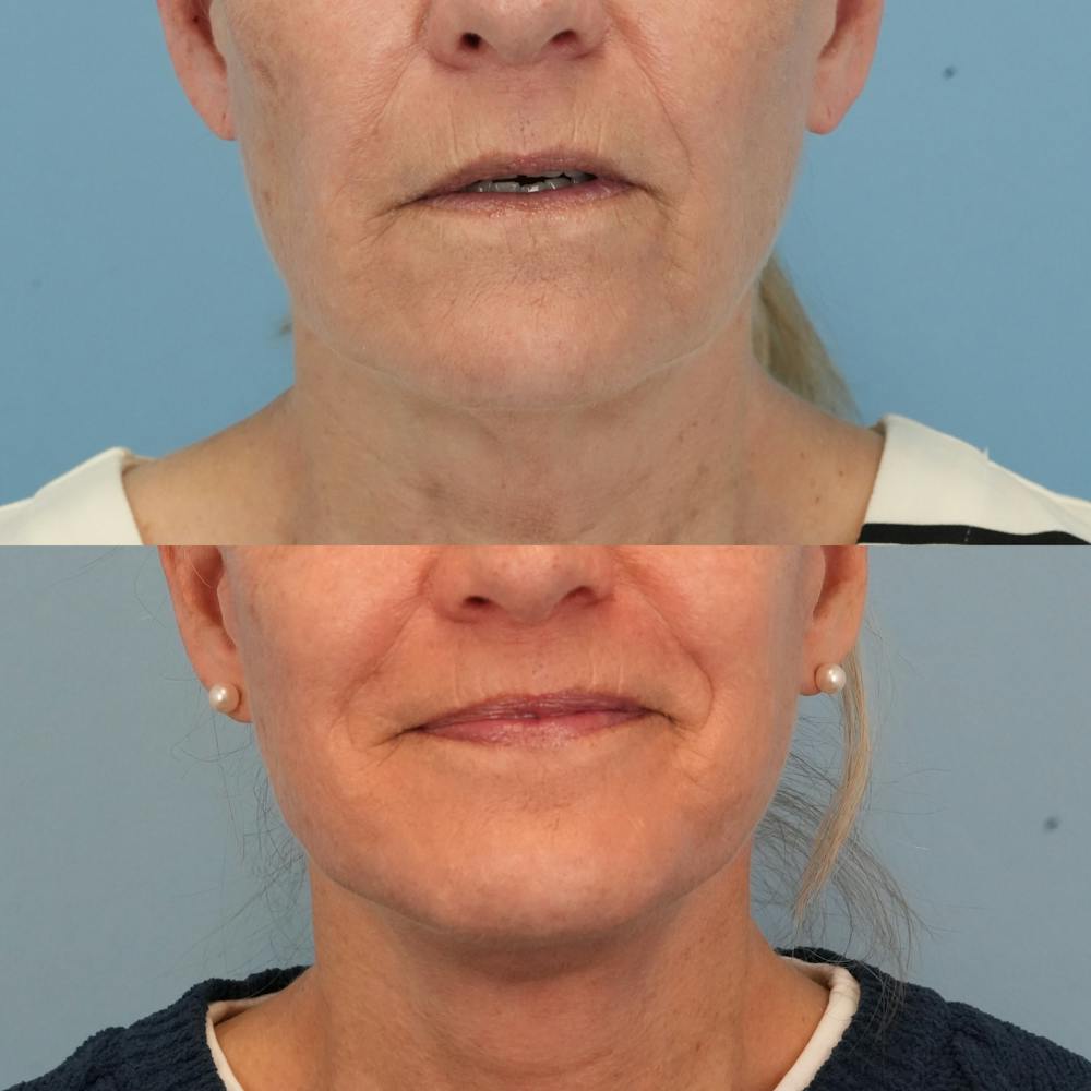 Facelift Before & After Gallery - Patient 277383 - Image 1