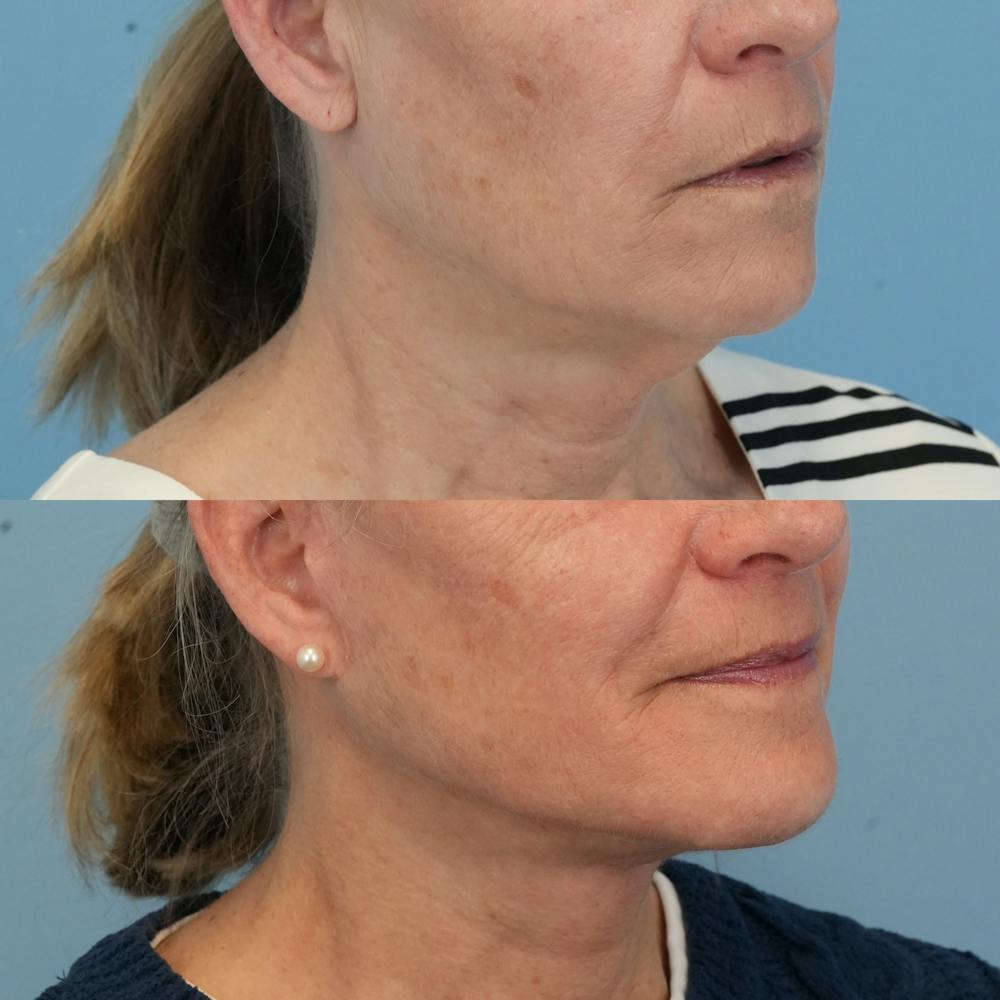 Facelift Before & After Gallery - Patient 277383 - Image 2