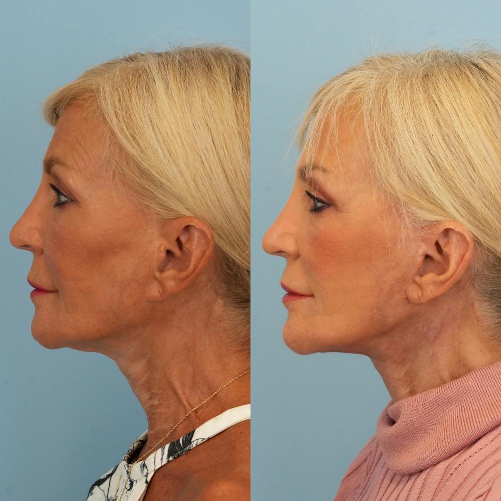 Facelift Before & After Gallery - Patient 242702 - Image 5