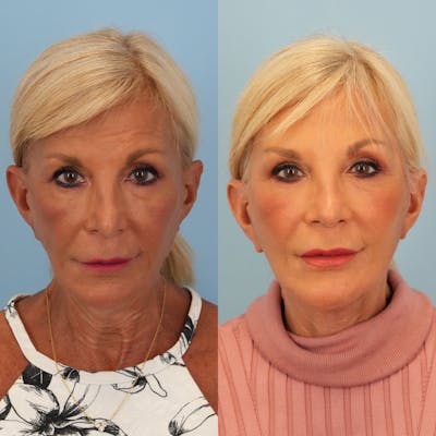 Facelift Before & After Gallery - Patient 242702 - Image 1