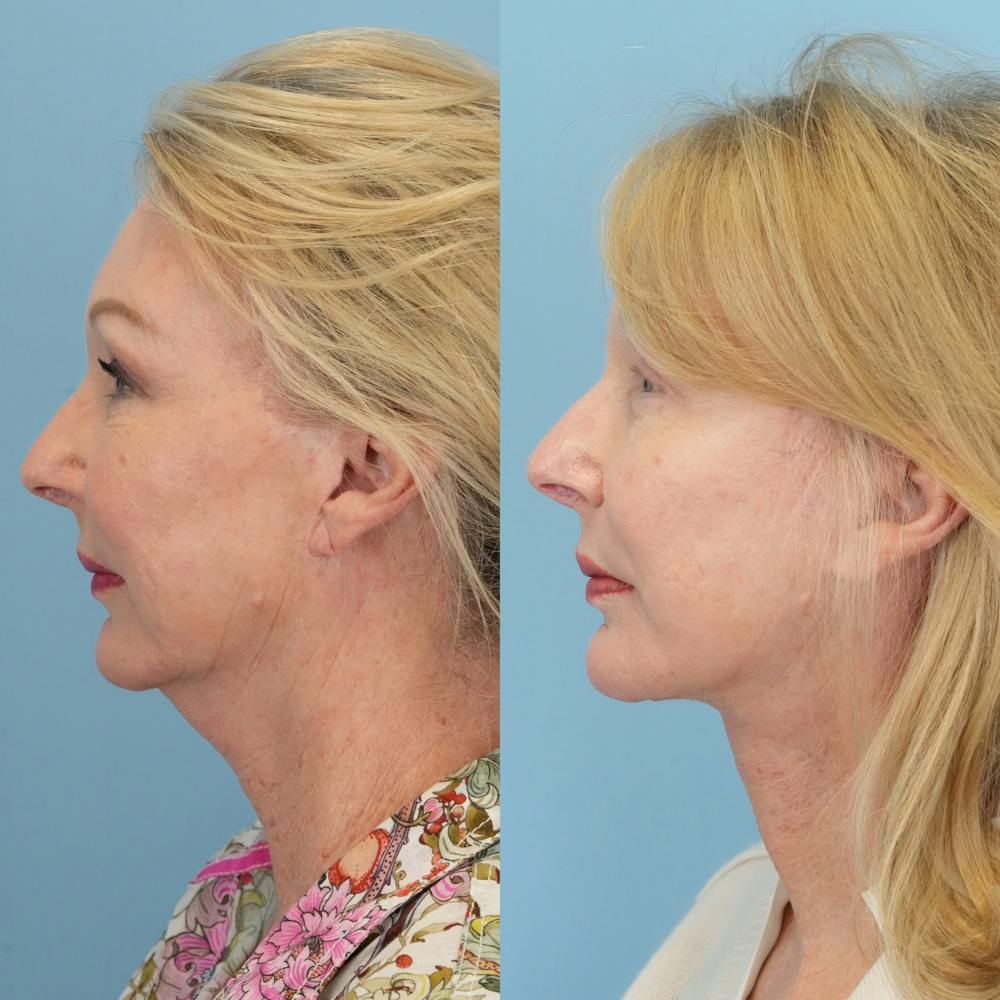 Facelift Before & After Gallery - Patient 230040 - Image 5