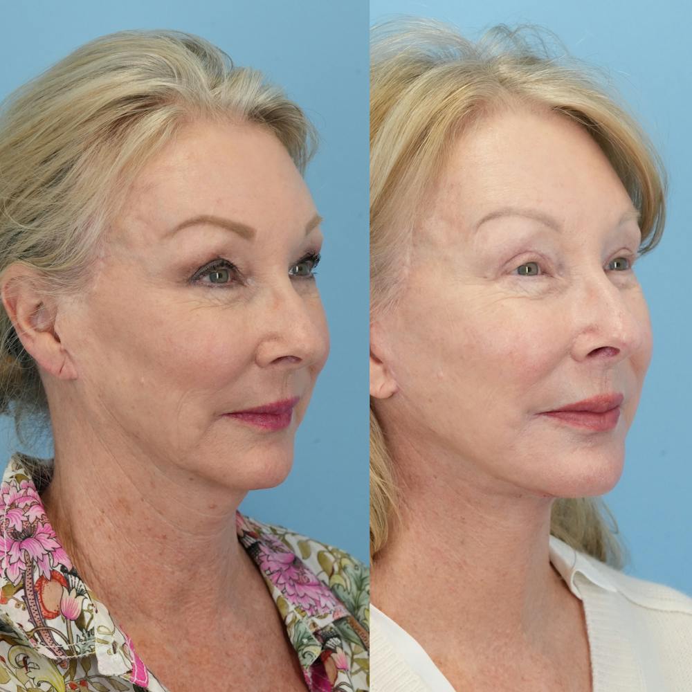 Facelift Before & After Gallery - Patient 230040 - Image 2