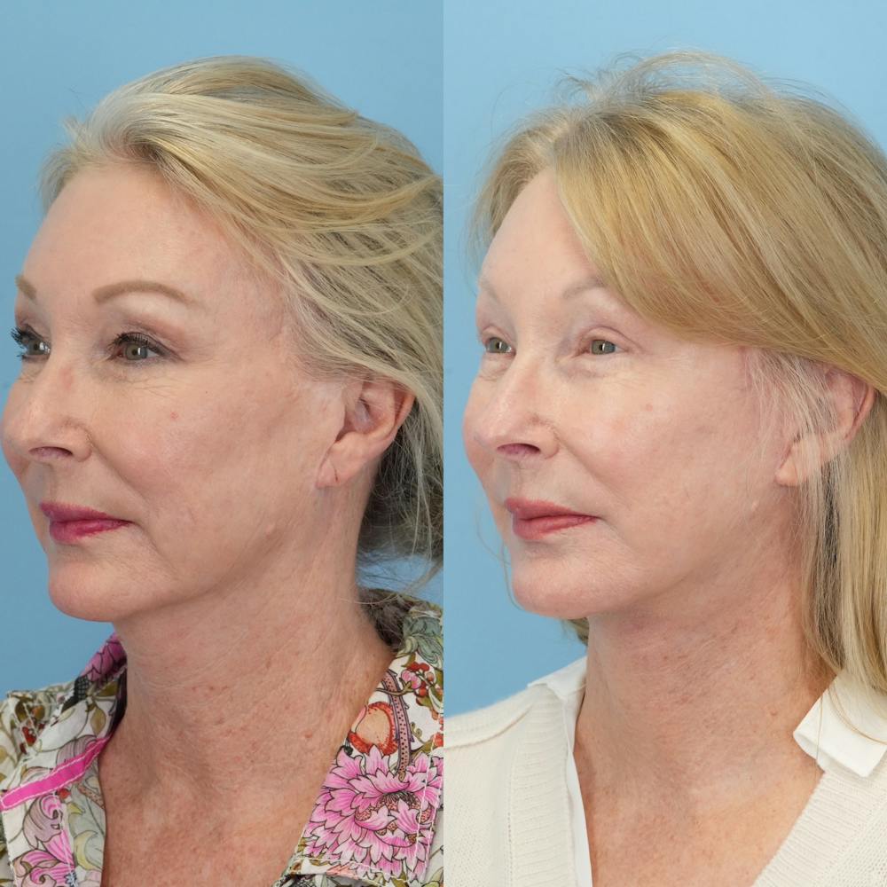 Facelift Before & After Gallery - Patient 230040 - Image 4