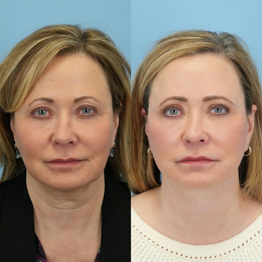 Facelift Before & After Gallery - Patient 226673 - Image 1