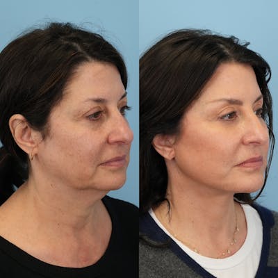 Facelift Before & After Gallery - Patient 125092 - Image 2