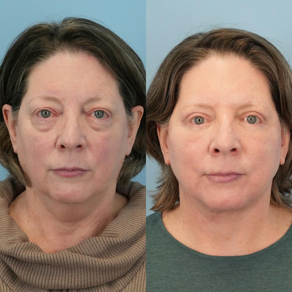Facelift Before & After Gallery - Patient 322805 - Image 1