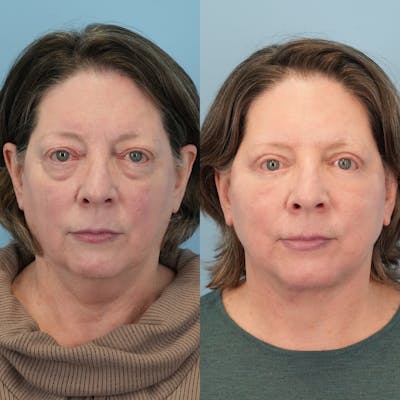 Facelift Before & After Gallery - Patient 322805 - Image 1