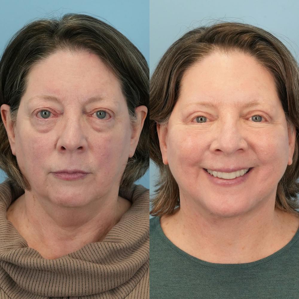 Facelift Before & After Gallery - Patient 322805 - Image 2