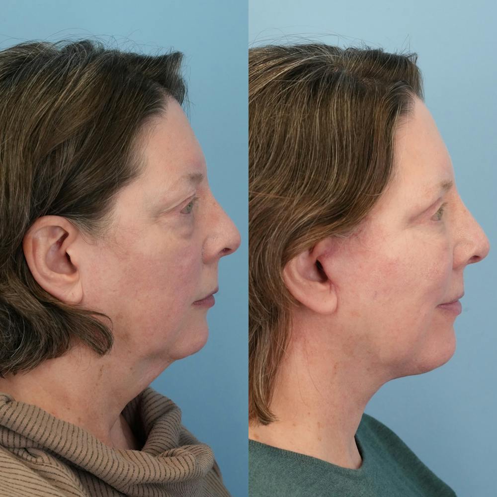 Facelift Before & After Gallery - Patient 322805 - Image 5