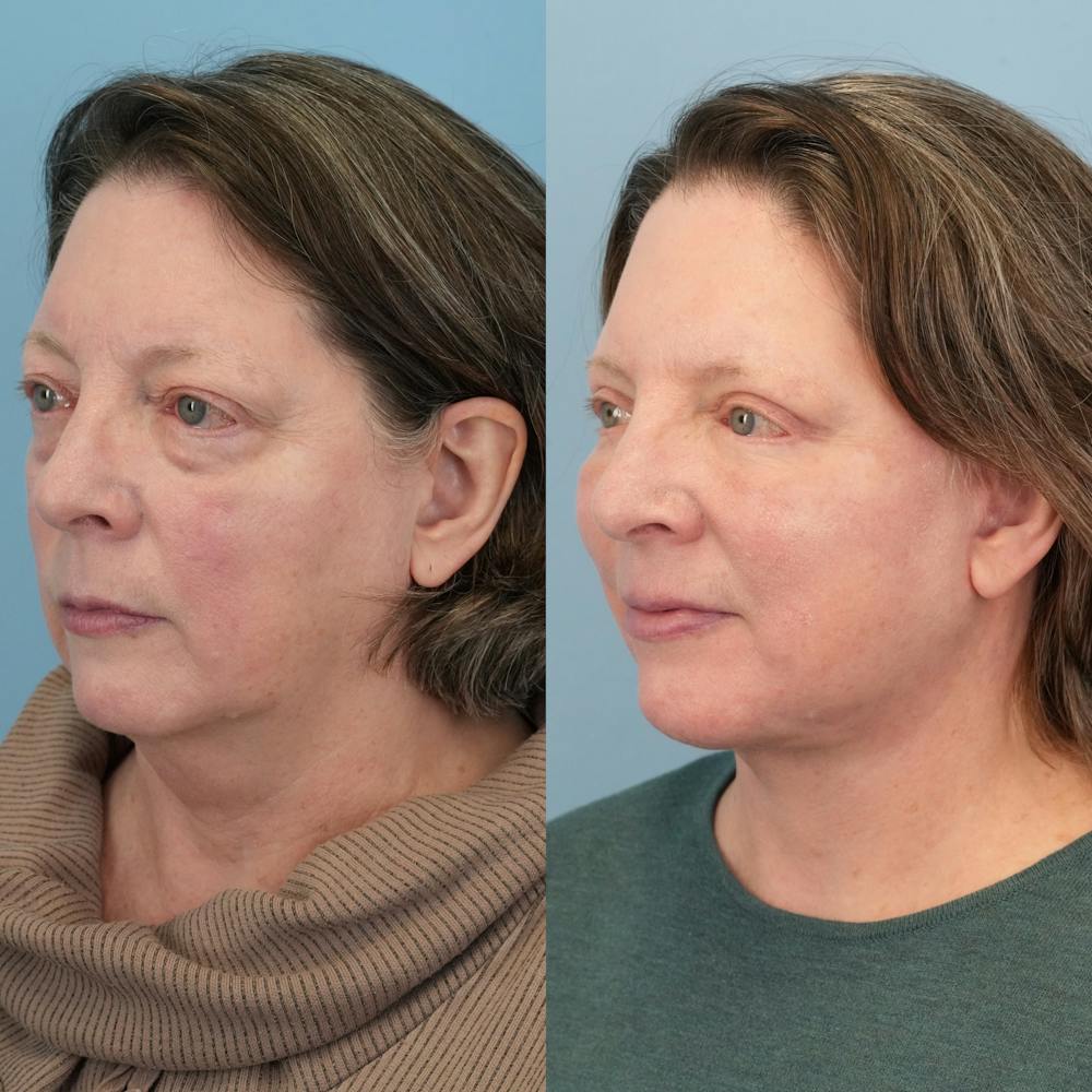 Facelift Before & After Gallery - Patient 322805 - Image 3