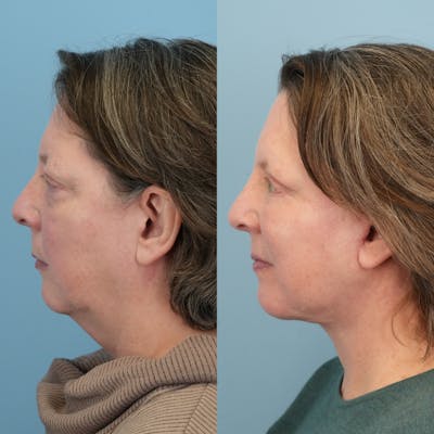 Facelift Before & After Gallery - Patient 322805 - Image 4