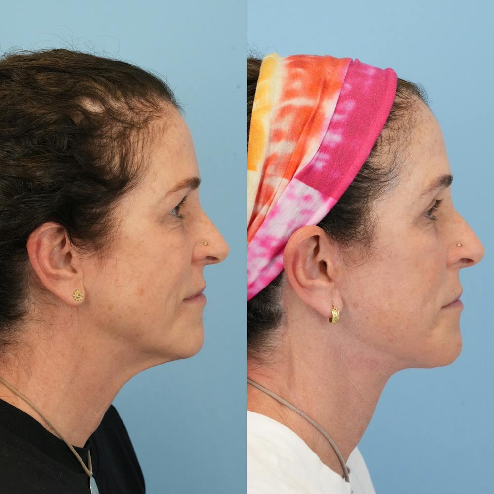 Facelift Before & After Gallery - Patient 719613 - Image 3