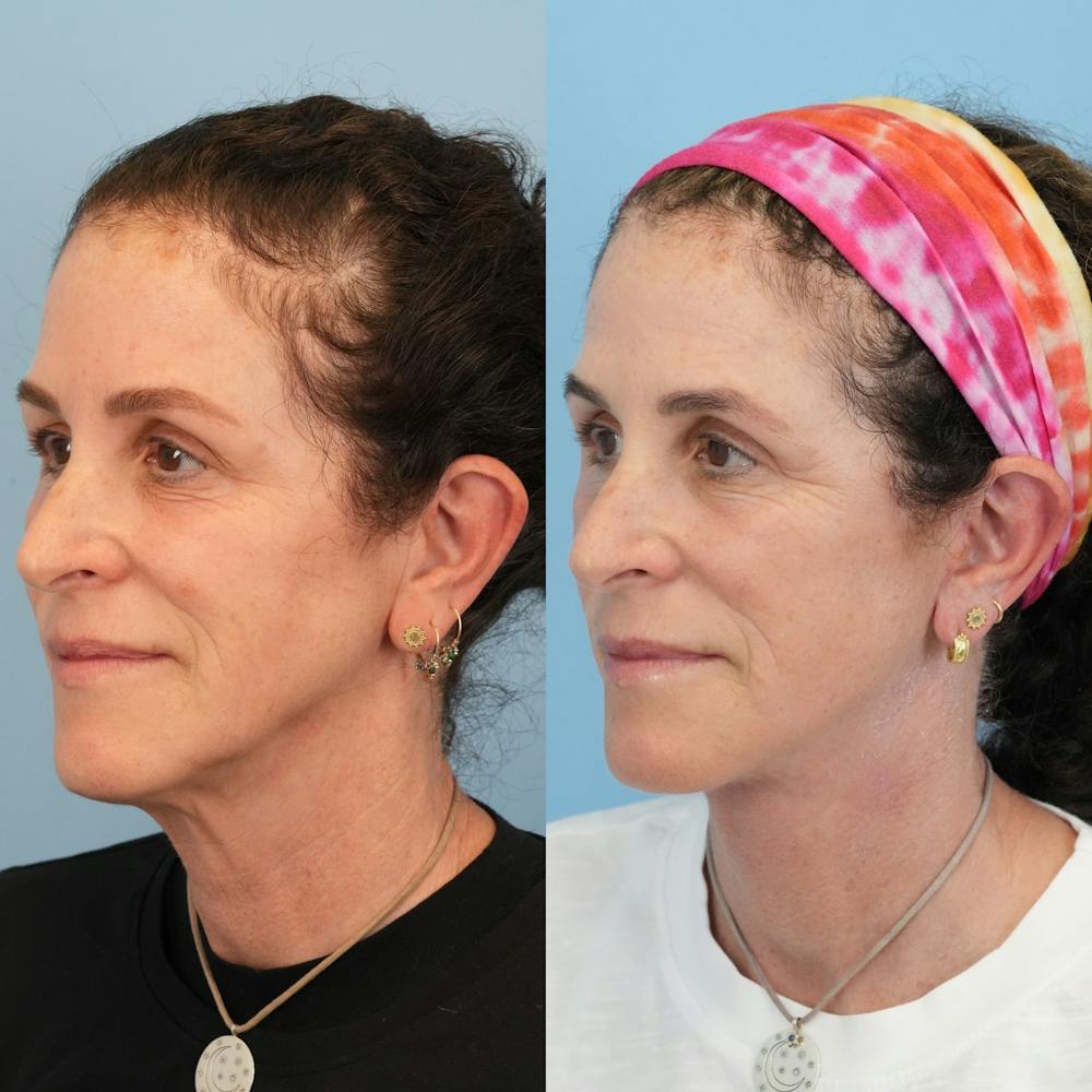 Facelift Before & After Gallery - Patient 719613 - Image 4