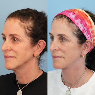 Facelift Before & After Gallery - Patient 719613 - Image 4