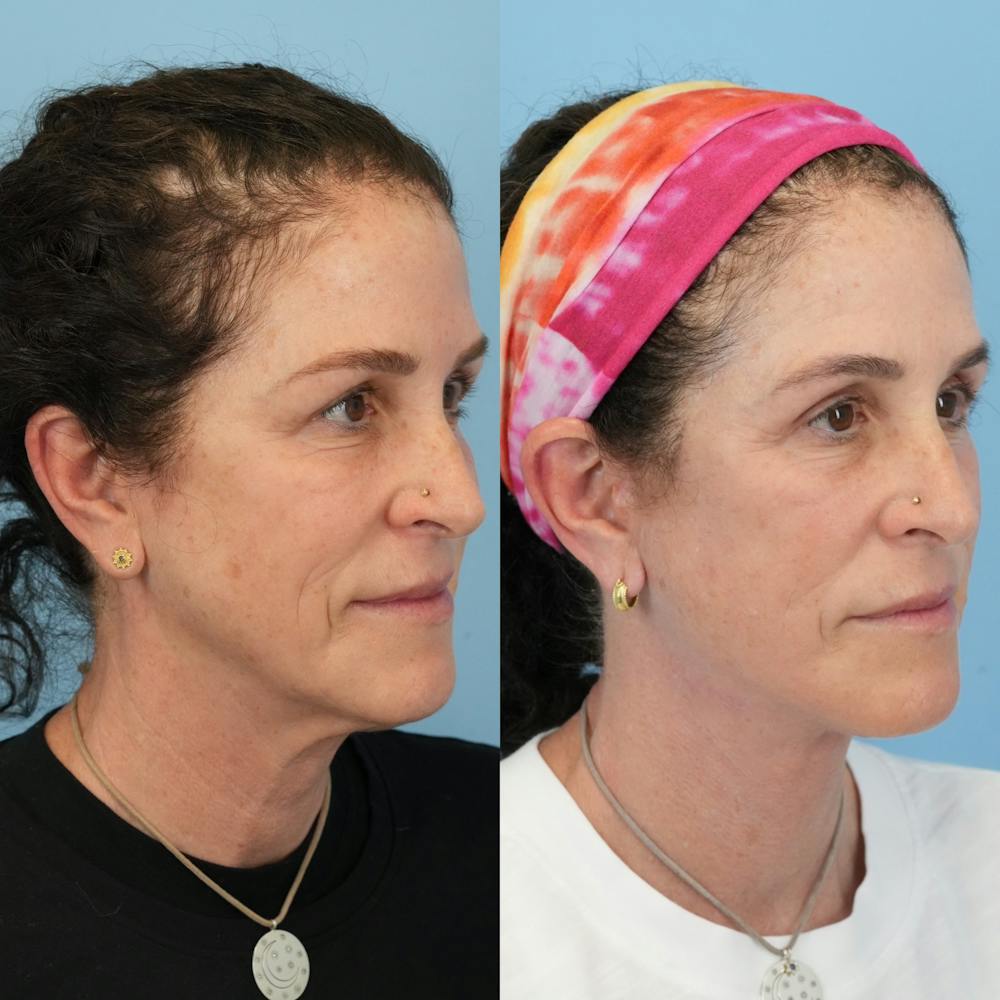 Facelift Before & After Gallery - Patient 719613 - Image 2